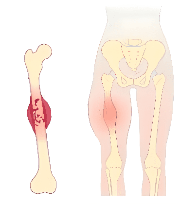 Ewing-sarcoma