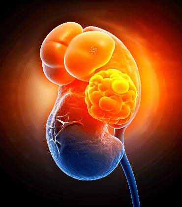 kidney-cancer