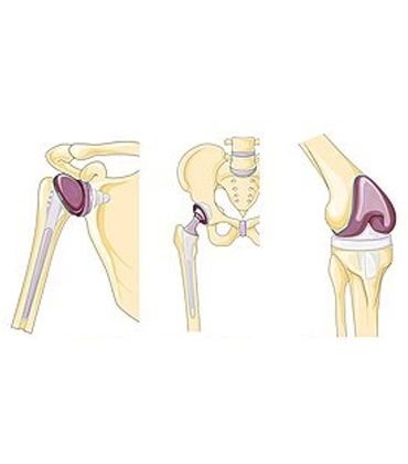 Limb-Sparing-Surgery