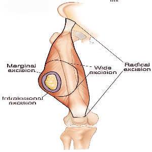 Margin-Sparing-Surgery
