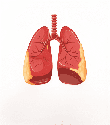Mesothelioma