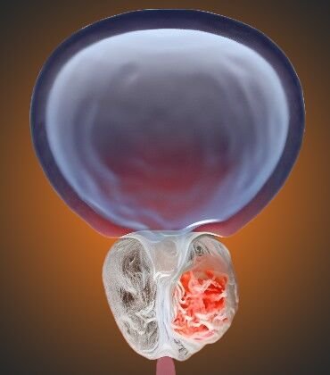 prostate-cancer