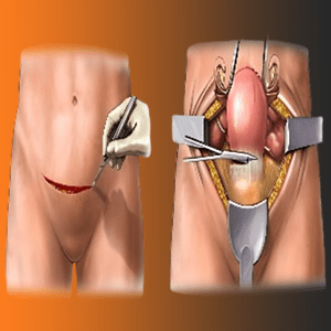 radical-hysterectomy