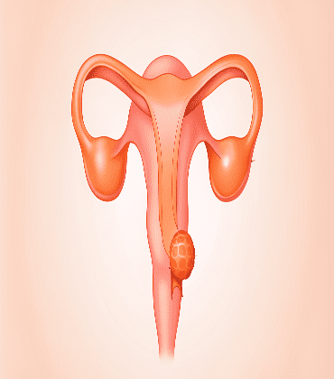 vaginal-cancer