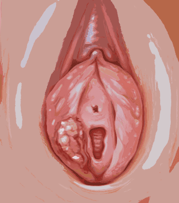 vulvar-cancer