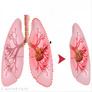 pneumonectomy