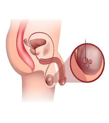 testicular-cancer